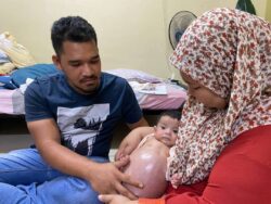 Perut anak membesar hingga 52 sentimeter